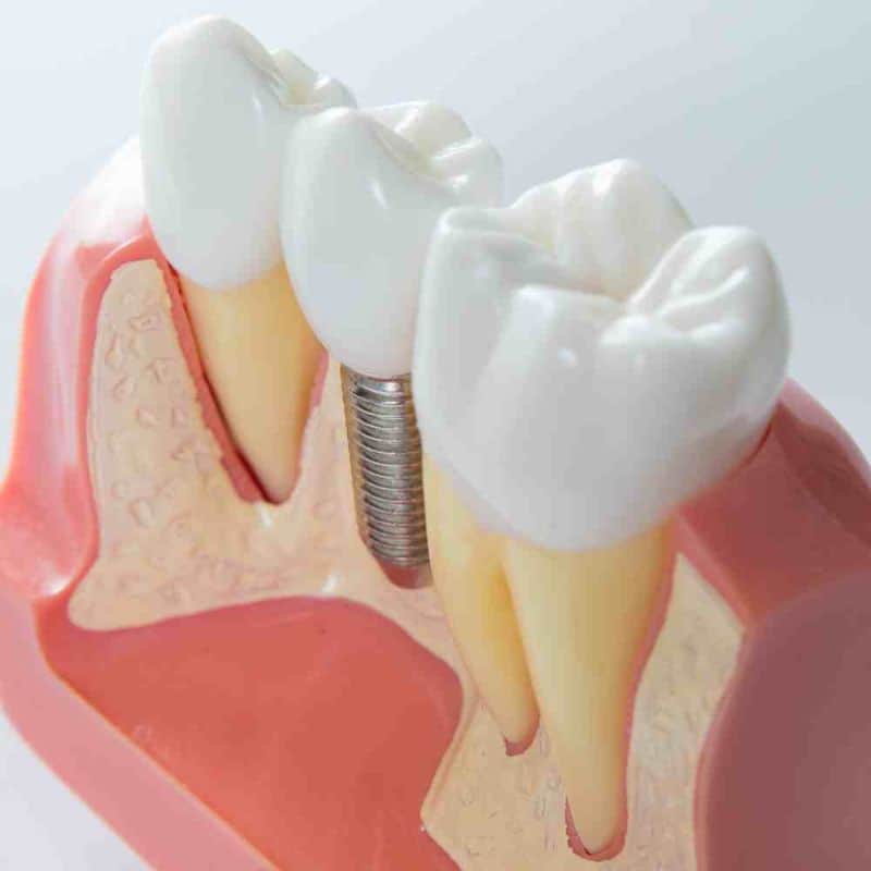 injerto de hueso dental