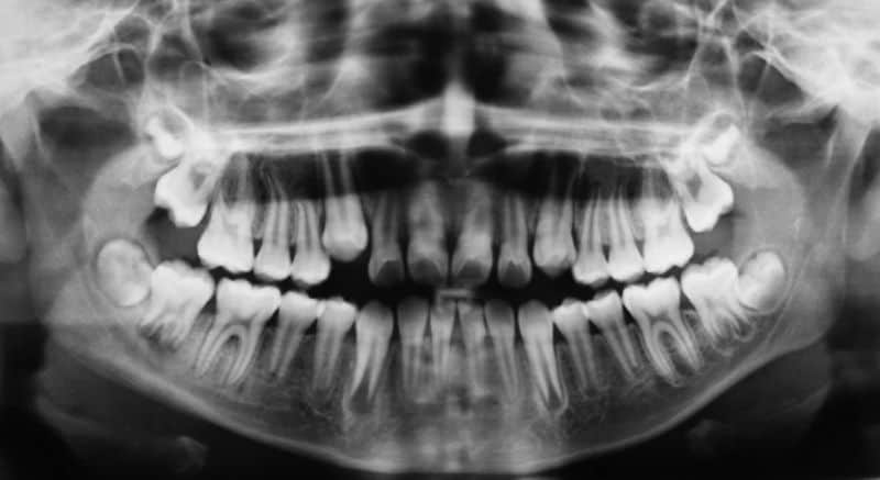 radiografía panorámica dental